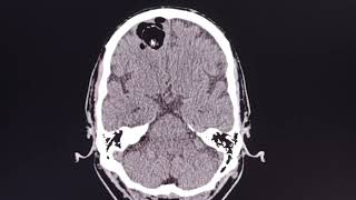 Dermoid cyst  ruptured   rare intracranial lesion [upl. by Notlrahc762]