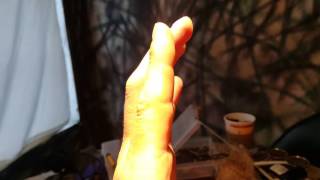 Flexor tendon surgery 10 weeks post op [upl. by Kcirdderf]