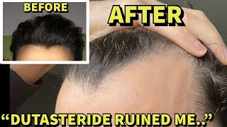 He Took Topical Dutasteride And THIS Happened Hairline DESTROYED [upl. by Suirada]