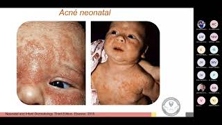 Dermatologia Pediatrica para Pediatras [upl. by Schober]