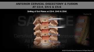 Anterior Cervical Discectomy amp Fusion at C34 C45 amp C56 [upl. by Potash189]