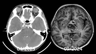 11 year old girl with sellar mass biopsy in November mixed tumor germinoma and mature teratoma [upl. by Aivizt]