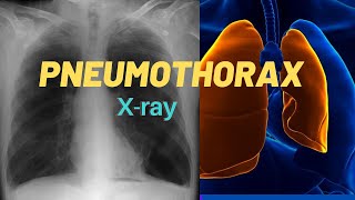 How to Interpret a Chest XRay Lesson 7  Diffuse Lung Processes [upl. by Aldis879]