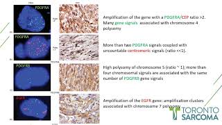 TTC 2023  Elizabeth G Demicco  Molecular Landscape Intimal Sarcoma [upl. by Inalem]