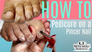 HOW TO DO A PEDICURE on a Pincer Toenail [upl. by Leafar430]