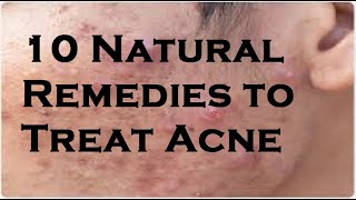 10 Natural Remedies to Treat Acne [upl. by Lasala263]