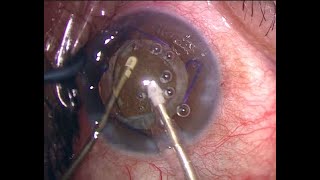 Retained Lens Removal 5 years after Cataract Surgery [upl. by Duyne]