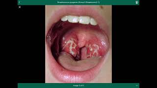 streptococcus pyogenes  العقدية القيحية [upl. by Ekal]