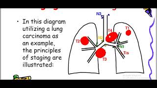 Lung carcinoma [upl. by Myer338]