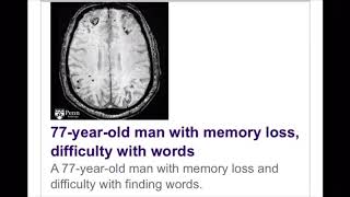 Cerebral amyloid angiopathy [upl. by Iew]