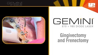 Gingivectomy and Frenectomy for Orthodontics  How to Use the Gemini™ Laser [upl. by Anikes924]