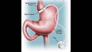 Roux en Y Gastric Bypass [upl. by Atnicaj]