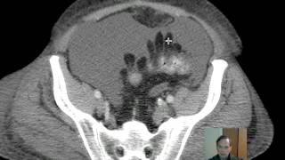 CT Epiploic Appendages Discussion [upl. by Doley212]