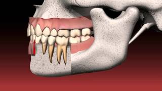 What is a dental bridge [upl. by Bohman177]