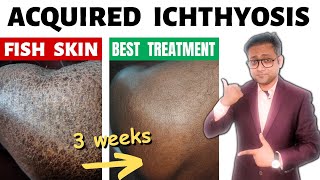 Acquired ichthyosis  Fish skin  Treatment  Hindi [upl. by Dustie]