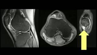 RM do joelho  Fricção tendão patelar  côndilo femoral lateral [upl. by Ertemed419]