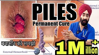 बवासीर  Piles  Hemorrhoids  समझो कारन से इलाज तक । १०० विज्ञान  हिंदी में ENG SUBTITLES [upl. by Nanoc]