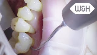 Tigon and periodontology tips 4P 5PI 5P English [upl. by Naillimxam]