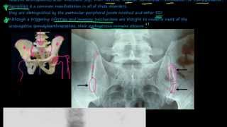 96P Introduction to the Seronegative Spondyloarthropathies [upl. by Lananna]