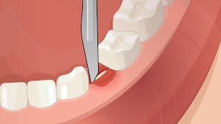 Dental Surgery Operation Root Canal Implant Anesthesia [upl. by Donielle494]