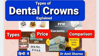 Dental Crowns Types Price amp Comparison  Explained in hindi Eng Subtitle [upl. by Bertha945]