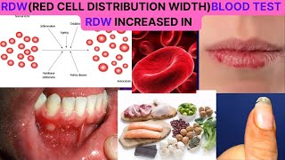 RDWRED CELL DISTRIBUTION WIDTH BLOOD TEST NORMAL RANGE CAUSES OF HIGH RDW HOW TO REDUCE IT [upl. by Hwang]