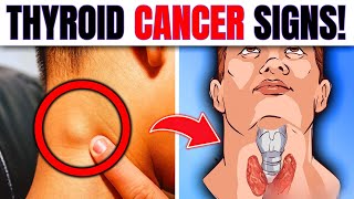 10 WARNING Signs Of Thyroid Cancer You Must Not IGNORE [upl. by Emixam996]