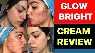 melasma treatment cream in hindi  acne removal cream  pimples ka cream [upl. by Haorbed770]