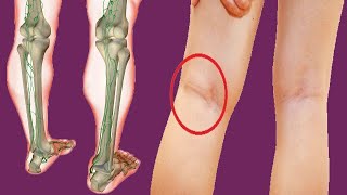 Swollen Popliteal Lymph Nodes Behind Knee Causes And Treatment [upl. by Siana230]