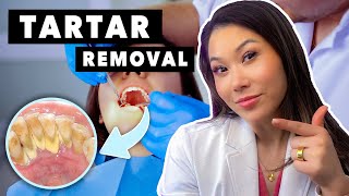 What is Tartar and How to Remove it [upl. by Portia]