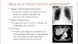 COMO CURAR UNA HERNIA EN EL ESTOMAGO Aprende Como Eliminar Una Hernia En El Ombligo [upl. by Kirkpatrick807]