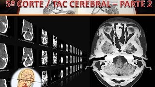 TAC Cerebral 5to corte parte 2 [upl. by Audette]