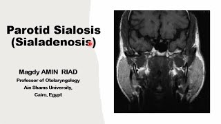 Parotid Sialosis Salivary Sialoadenosis [upl. by Tnilf]