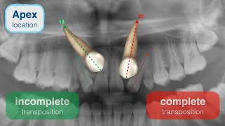 Impaction diagnosis amp treatment protocol  Part 3｜【Chris Chang Ortho】CC780 [upl. by Siouxie]