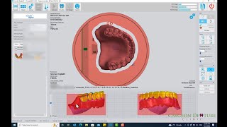 Nesting CUDCLD for Milling on Ivoclars PM7 [upl. by Ahsilrae]