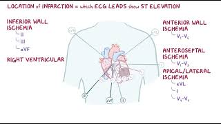 Clinical Reasoning  Coronary Artery Disease  Osmosis [upl. by Tansy605]