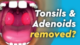 Tonsils and Adenoids Surgery [upl. by Arihsan]