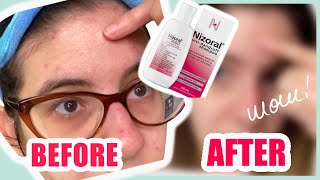 Nizoral Shampoo Against Fungal Acne  Is it Effective [upl. by Honniball624]