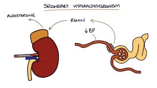 Hyperaldosteronism and Conns Syndrome [upl. by Skurnik]