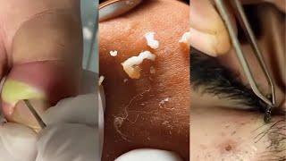 Unleashing Pimple Popper The Ultimate Satisfaction [upl. by Etnauq]