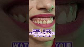 Watch if your Gums show too much on Smiling Dr Srishti Bhatia gummysmile smile laser [upl. by Winnie847]