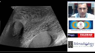 Fournier Gangrene Diagnosis teaching by Dr Arjun Kalyanpur [upl. by Eitsirc]