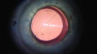 Centering a multifocal IOL on the subjectfixated coaxially sighted corneal light reflex [upl. by Eleda]