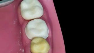 full metal crown preparation part 1 occlusal reduction ❤️شرح مبسط [upl. by Aiek]