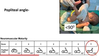 Gestational Age Estimation in Newborn  Newborn Examination Part4  Pediatrics [upl. by Ariada]