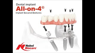 Proteza Fixa cu 4 Implanturi Pret Implant dentar Allon4  Allon6 Nobel Biocare [upl. by Royce]