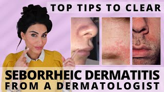 Top Tips to Clear Seborrheic Dermatitis  Dermatologist Deep Dive [upl. by Nnylyar675]