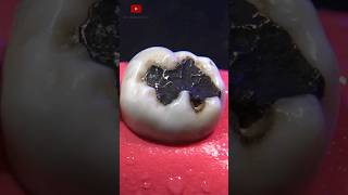 Restauración dental satisfying [upl. by Asile]