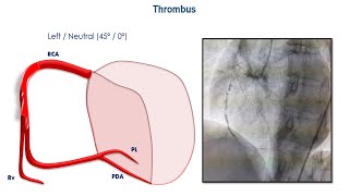 Angiographic lesions cardiology cardiologyfellow unam anahuac medicina anatomy [upl. by Aivartal518]