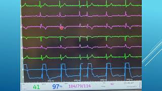 7 Pericardiocentesis  Confirming Location [upl. by Collie]